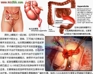 阑尾炎 阑尾炎