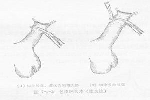 阴茎癌 阴茎癌