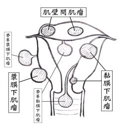 子宫肌瘤 子宫肌瘤