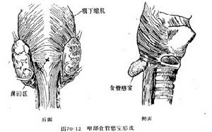 食管憩室