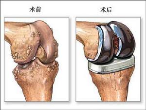 髌骨骨折 髌骨骨折