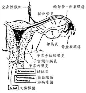 引产