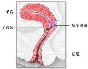 子宫息肉